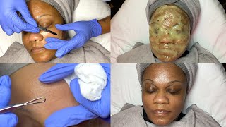 Dermaplaning Facial on Oily Mature Skin  GlamByLiaLeigh [upl. by Haret]