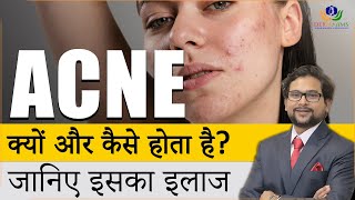 What Causes Acne and How to Treat it  Causes of Acne on face  Acne Treatment in Delhi  DermAiims [upl. by Ocram917]