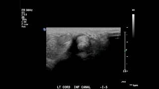 ultrasound of a testicular torsion knot in the cord [upl. by Reggie]