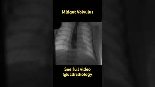 Midgut volvulus pediatrics radiology medicine doctor radiologyresident medicalstudent [upl. by Milewski]