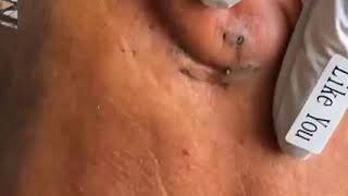 👌Satisfying acne removal  Traitement de lacné et points noirs en dessous de loreille [upl. by Nylessoj820]