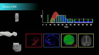 Complete Brain Perfusion Imaging in Just One Minute [upl. by Gonagle565]