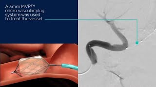 Discover Medtronics MVP™ micro vascular plug System and Concerto™ detachable coil system [upl. by Beverlee]