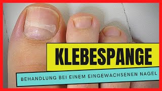 EINGEWACHSENEN NAGEL mit einer KLEBESPANGE behandeln  Podostripe Klebespange [upl. by Boggs]