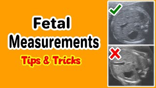 Fetal Measurements Tips and Tricks [upl. by Anauj]