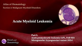 Acute Myeloid Leukemia AML  Part 3 [upl. by Delmer]