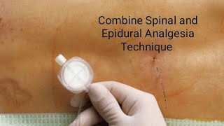 Combined SpinalEpidural Anesthesia Technique [upl. by Alehs804]