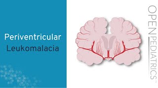 quotPeriventricular Leukomalaciaquot by Anne Hansen MD MPH for OPENPediatrics [upl. by Cochran]