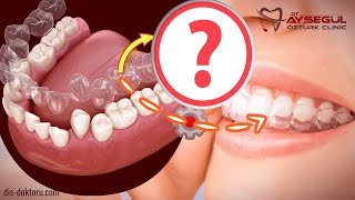 Yeni Telsiz Ortodonti 😁  Şeffaf Plak Tedavisi ❓  Invisalign ❓ [upl. by Goar]