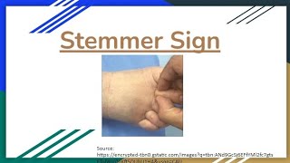 Stemmer Sign  Novice Medic [upl. by Suired]