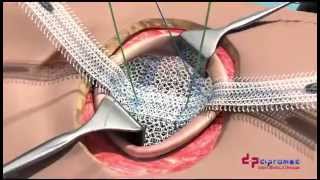 UCMC ClearMesh Composite  Umbilical Hernia Repair [upl. by Leidag]