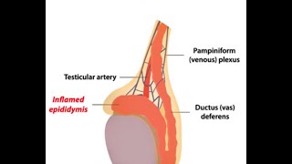 Epididymitis [upl. by Mauri249]