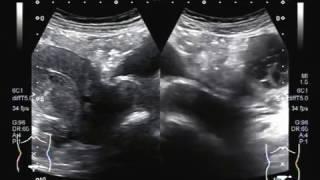 Ultrasound Video showing Haemorrhagic ovarian cyst HOC [upl. by Nirahs]