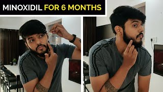 I Tried quot MINOXIDIL quot for 6 Months   Honest Results  🇮🇳 [upl. by Otir743]