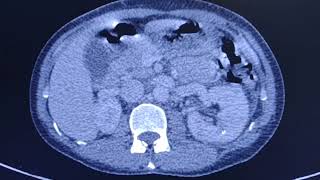 Acute pyelonephritis  CT findings [upl. by Eel]