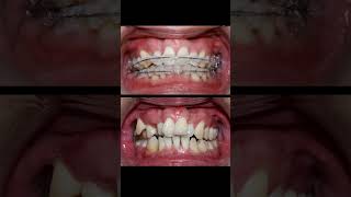 Braces process 3 years braces niengrang dentist [upl. by Means549]