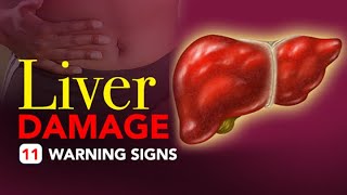 Liver Damage  11 Warning Signs [upl. by Poll888]