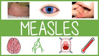 Measles  Features Management and Mnemonics [upl. by Dionne]