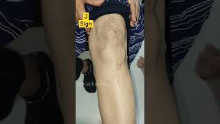 J sign  Patella Maltracking  Trochlear Dysplasia  MPFL injury shorts ortho Dr Prateek Joshi [upl. by Agler817]