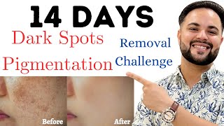 14 Days Dark Spots amp Pigmentation Removal Challenge  100 Results [upl. by Lilia962]