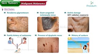 Malignant Melanoma Risk factors Types Characteristic features Diagnosis Surgery [upl. by Suirada848]