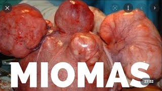 Miomas uterinos live de dúvidas com Dr Michel Palheta [upl. by Otir]