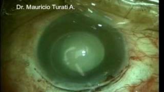 CATARACT SURGERY IN PHACOLYTIC GLAUCOMA  Dr Mauricio Turati Acosta [upl. by Elbertina]