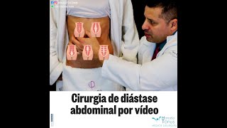 CIRURGIA DE DIÁSTASE POR VÍDEO [upl. by Wilscam]