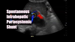 Spontaneous Intrahepatic Portosystemic Shunt [upl. by Nymsaj]