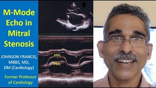 MMode Echo in Mitral Stenosis [upl. by Hullda]