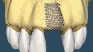 Implantes Dentários  Com Enxerto Ósseo [upl. by Noseyt]