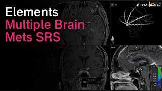 Radiosurgery Solution for Treatment of Multiple Brain Metastases  Multiple Brain Mets SRS [upl. by Boote278]