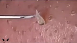 Satisfy Blackhead Removal  Nose Cystic Acne Treatment  Pimple Popping Extraction  Acne Spa  054 [upl. by Lilla758]