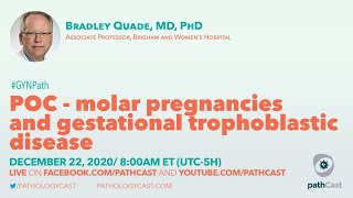 POC  molar pregnancies and gestational trophoblastic disease  Dr Quade BWH OBPATH [upl. by Sherry]