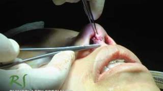 OR Video Footage Closing the Incisions After NoseJob [upl. by Prissy]