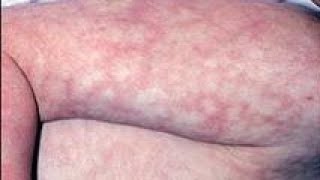 What is Livedo Reticularis Causes Treatment [upl. by Reivaxe]