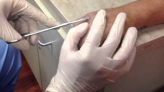 Broken Metacarpal KWire pin Removal [upl. by Erhard403]