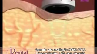 Lipocavitação  Lipo sem cirurgia [upl. by Showker]