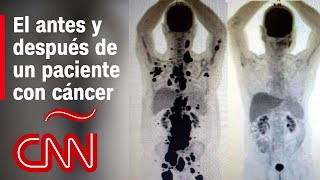 Antes y después de un paciente con cáncer que tuvo remisión en 1 mes gracias a terapia de células [upl. by Calloway]