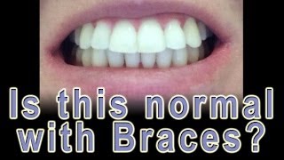 Adult Braces  Should my teeth flare [upl. by Ravaj]