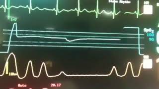 Cheyne Stokes Respiration recorded on cardiac monitor [upl. by Hermie133]