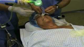 Fiberoptic Intubation [upl. by Yeneffit129]