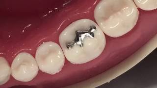 Class I Amalgam Cavity Preparation amp Restoration [upl. by Steffi]