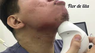 Skin Lifting amp Tightening for Arms Jawline amp Double Chin amp Face Using Endymed Pro Machine [upl. by Yelram]