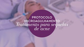 Protocolo Facial Antiacne Microagulhamento Tratamento para Sequelas de Acne [upl. by Zetnas694]