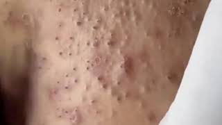 Popping huge blackheads and PimplePopping Best Pimple Popping Videos [upl. by Ahasuerus291]