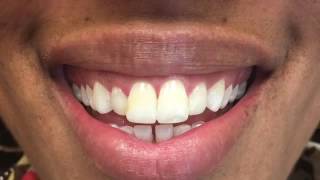 Teeth Bonding Procedure Teeth Bondng Before and After [upl. by Ayifas391]