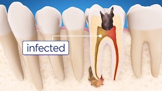 Root Canal Treatment Step by Step [upl. by Ennairod489]