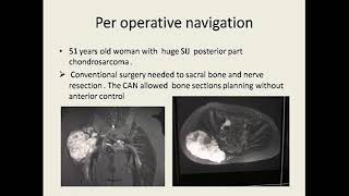 Les tumeurs osseuses malignes du Bassin [upl. by Aliber778]