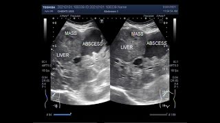 Ultrasound Video showing Hepatic Abscess with a mass [upl. by Htur424]